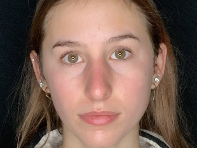 Patient #45695: Rhinoplasty After Image