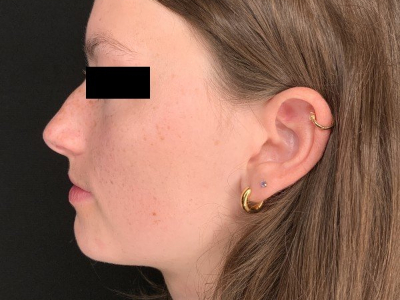 Patient #78452: Rhinoplasty Before Image
