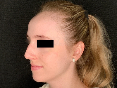 Patient #96589: Rhinoplasty Before Image
