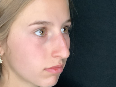 Patient #45695: Rhinoplasty Before Image