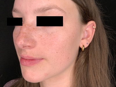 Patient #78452: Rhinoplasty Before Image