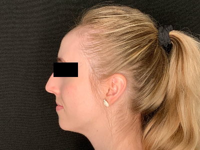 Patient #96589: Rhinoplasty Before Image