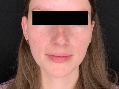 Patient #78452: Rhinoplasty Before Image