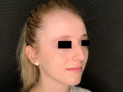 Patient #96589: Rhinoplasty Before Image