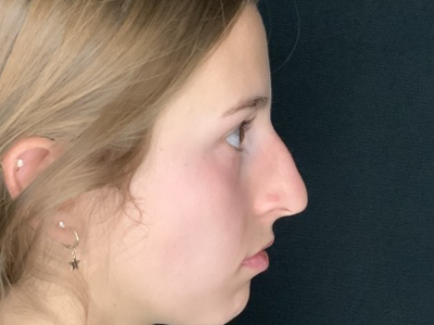 Patient #45695: Rhinoplasty Before Image