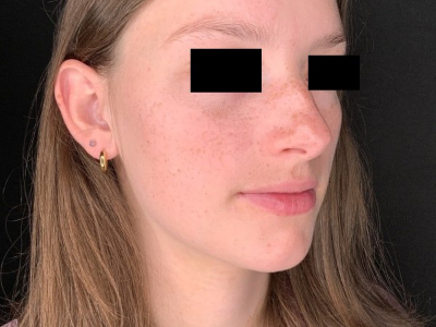 Patient #78452: Rhinoplasty Before Image