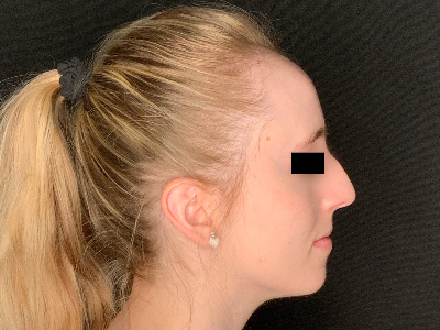 Patient #96589: Rhinoplasty Before Image