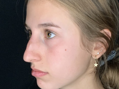 Patient #45695: Rhinoplasty Before Image