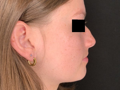 Patient #78452: Rhinoplasty Before Image