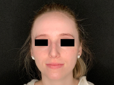 Patient #96589: Rhinoplasty Before Image