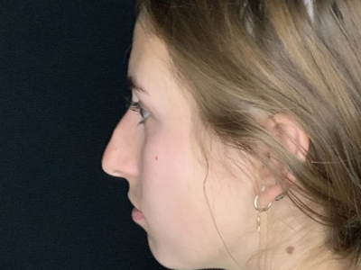 Patient #45695: Rhinoplasty Before Image