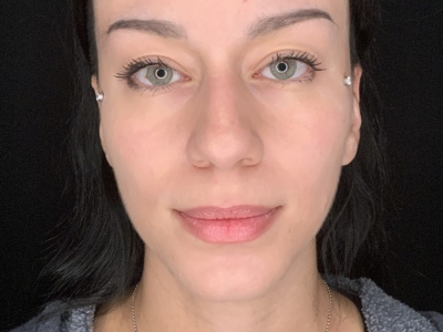 Patient #36974: Rhinoplasty Before Image