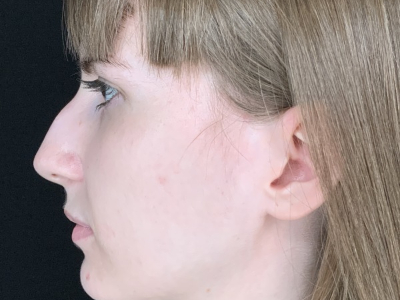 Patient #69547: Rhinoplasty Before Image