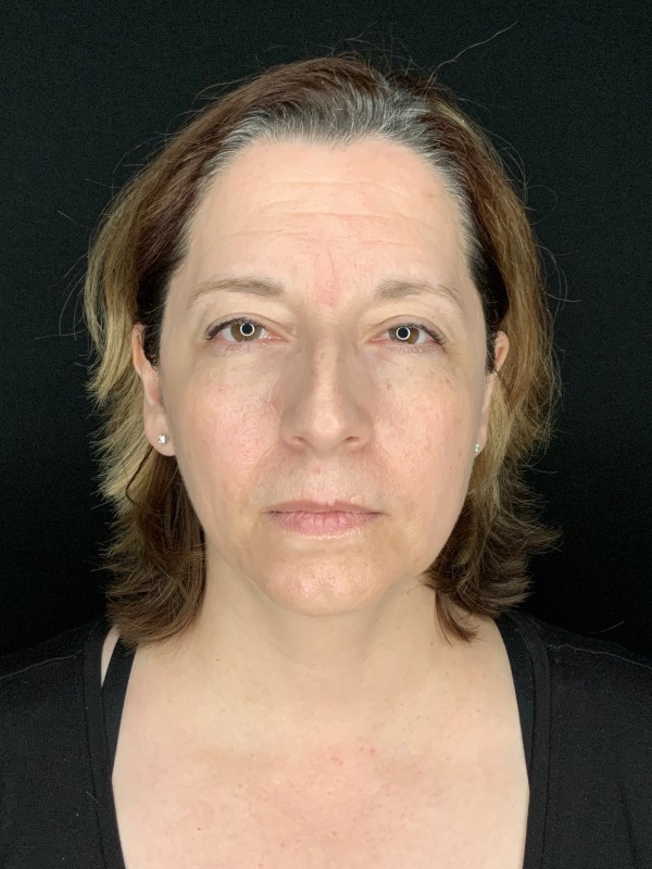 Patient #86595: Rhinoplasty & Chin Augmentation Before Image