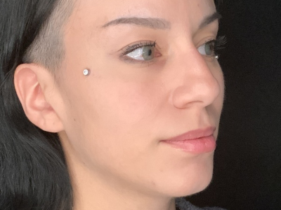 Patient #36974: Rhinoplasty Before Image
