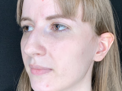 Patient #69547: Rhinoplasty Before Image