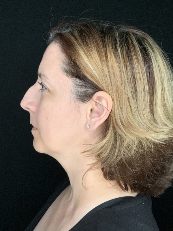 Patient #86595: Rhinoplasty & Chin Augmentation Before Image