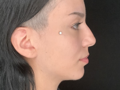 Patient #36974: Rhinoplasty Before Image