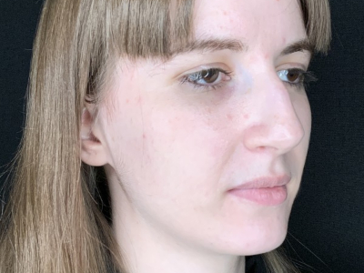 Patient #69547: Rhinoplasty Before Image