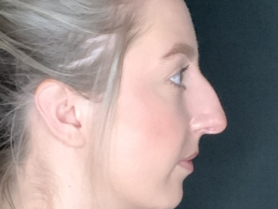 Patient #22669: Rhinoplasty Before Image