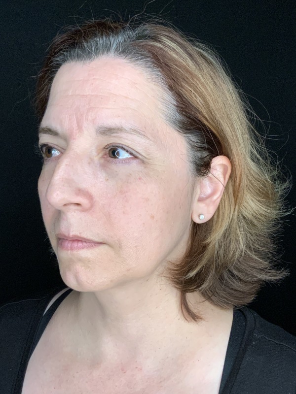 Patient #86595: Rhinoplasty & Chin Augmentation Before Image