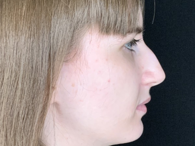 Patient #69547: Rhinoplasty Before Image