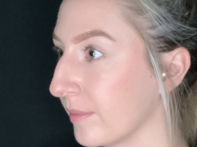 Patient #22669: Rhinoplasty Before Image