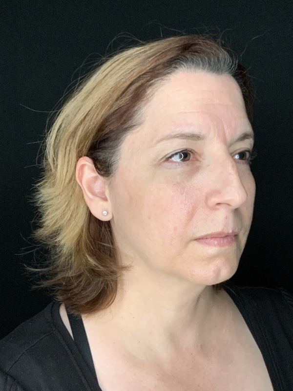 Patient #86595: Rhinoplasty & Chin Augmentation Before Image
