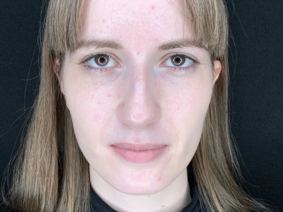 Patient #69547: Rhinoplasty Before Image