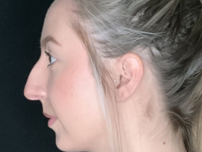 Patient #22669: Rhinoplasty Before Image