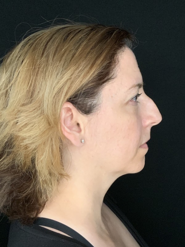 Patient #86595: Rhinoplasty & Chin Augmentation Before Image