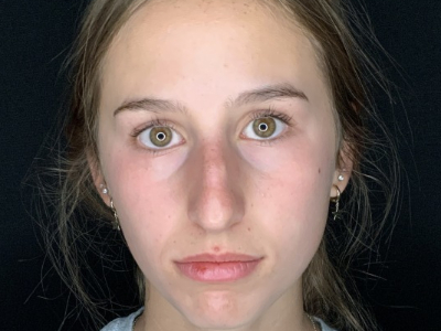 Patient #45695: Rhinoplasty Before Image