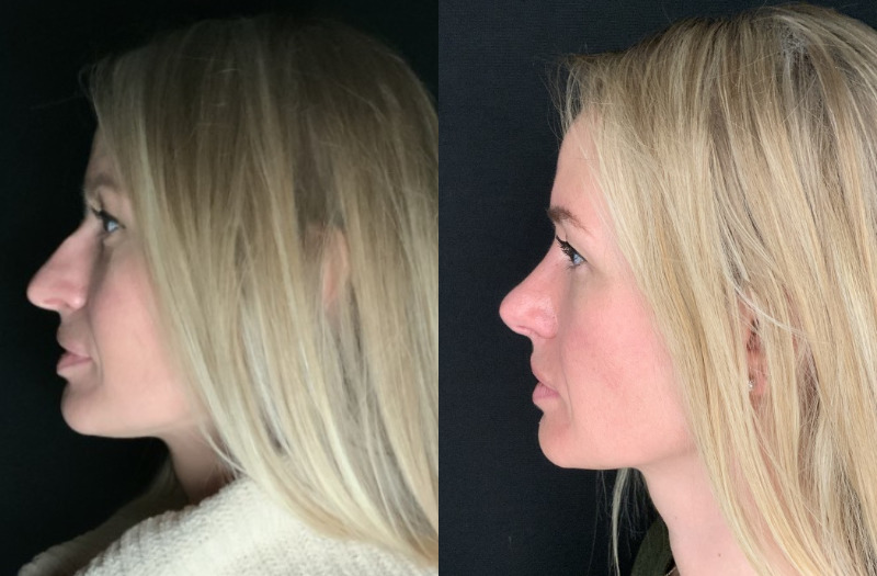 Patient #11478: Rhinoplasty Combine Image