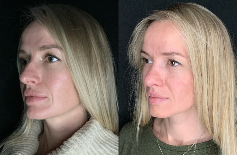 Patient #11478: Rhinoplasty Combine Image