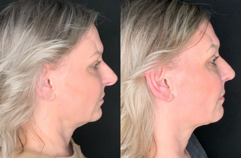 Patient #45863: Rhinoplasty Combine Image