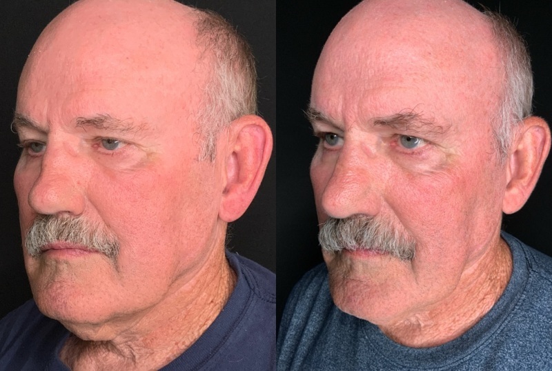 Patient #10399: Rhinoplasty Combine Image