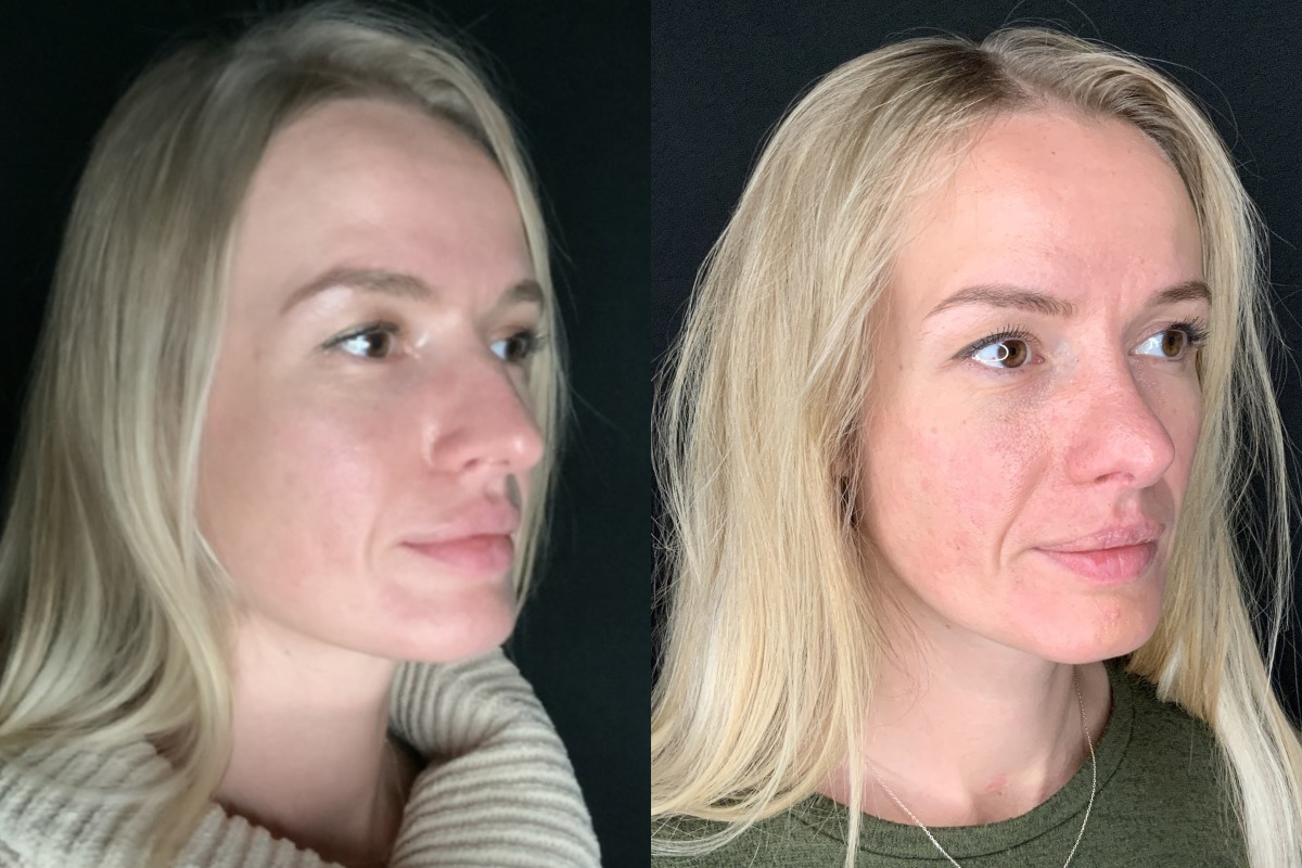 Patient #11478: Rhinoplasty Combine Image