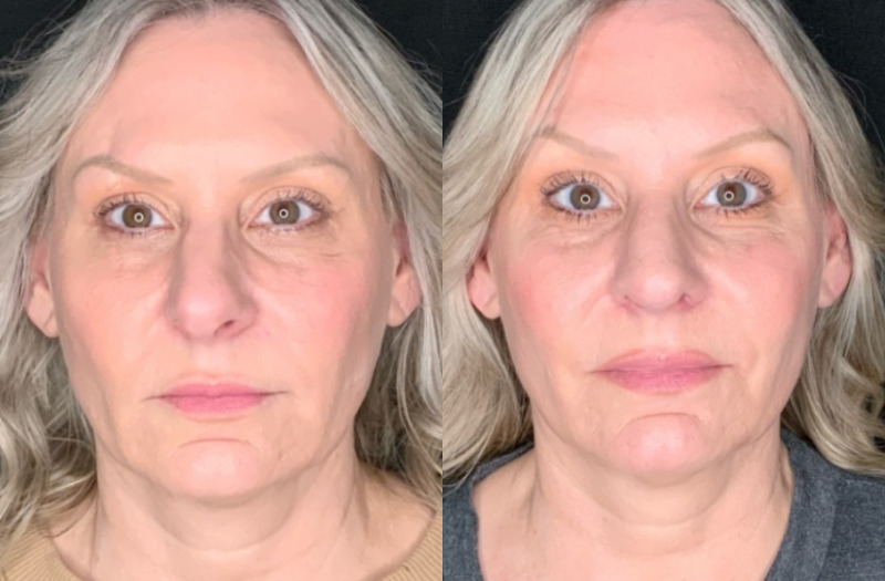 Patient #45863: Rhinoplasty Combine Image