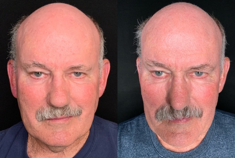 Patient #10399: Rhinoplasty Combine Image