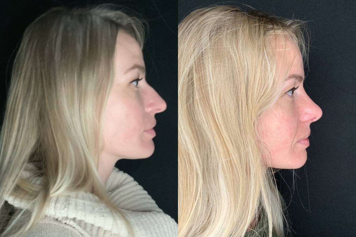 Patient #11478: Rhinoplasty Combine Image