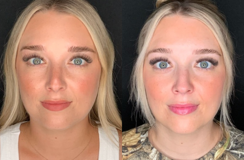 Patient #28457: Rhinoplasty Combine Image