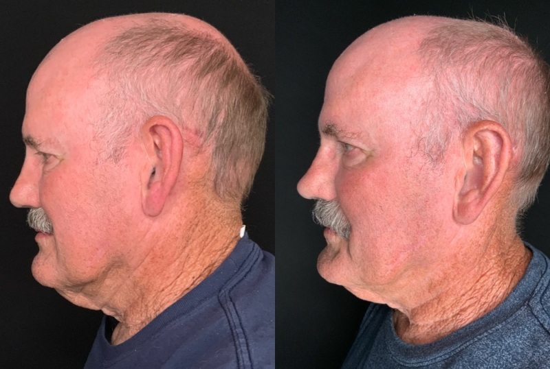 Patient #10399: Rhinoplasty Combine Image