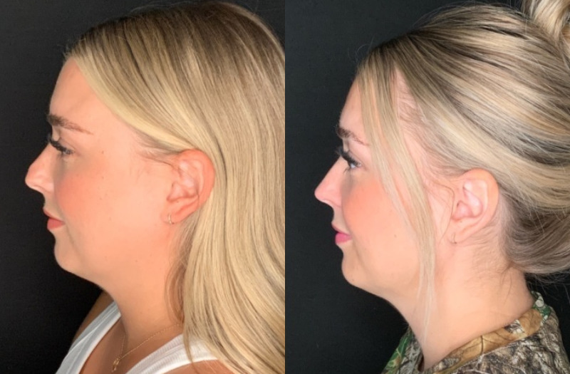 Patient #28457: Rhinoplasty Combine Image