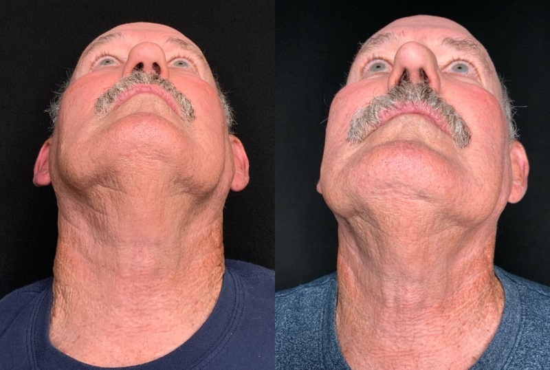 Patient #10399: Rhinoplasty Combine Image