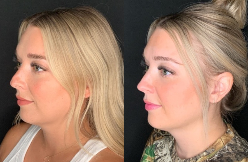 Patient #28457: Rhinoplasty Combine Image