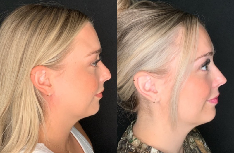 Patient #28457: Rhinoplasty Combine Image