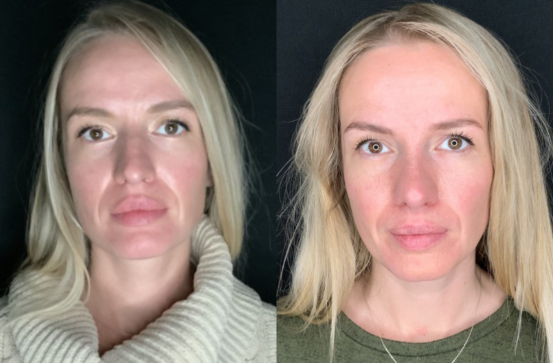 Patient #11478: Rhinoplasty Combine Image