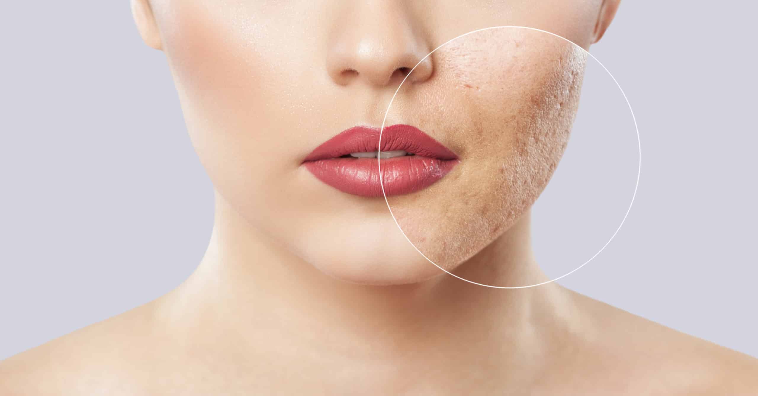What To Know About Laser Skin Resurfacing Image