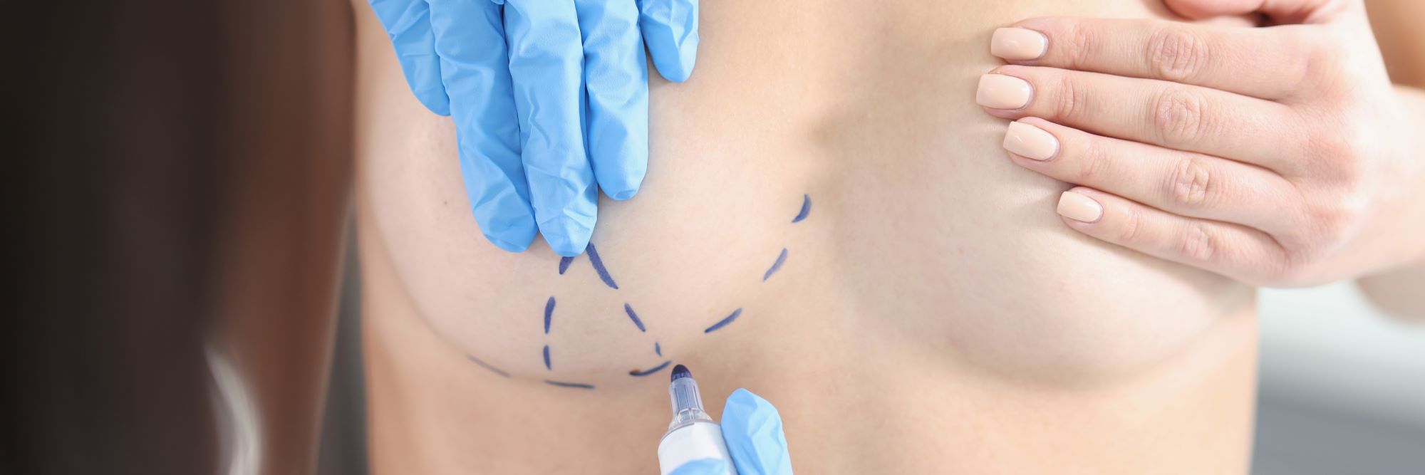 The Ultimate Guide to Breast Augmentation Image
