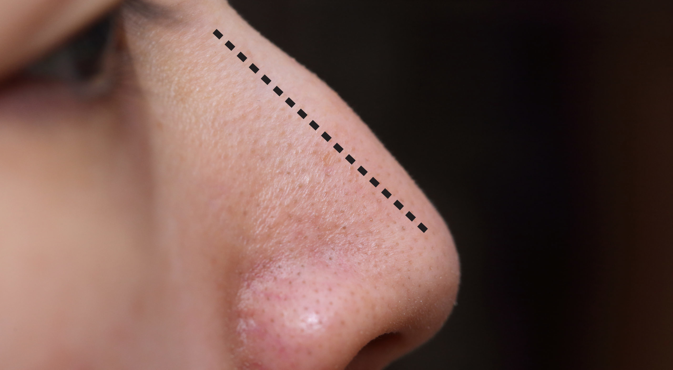 10 Rhinoplasty Recovery Tips Image